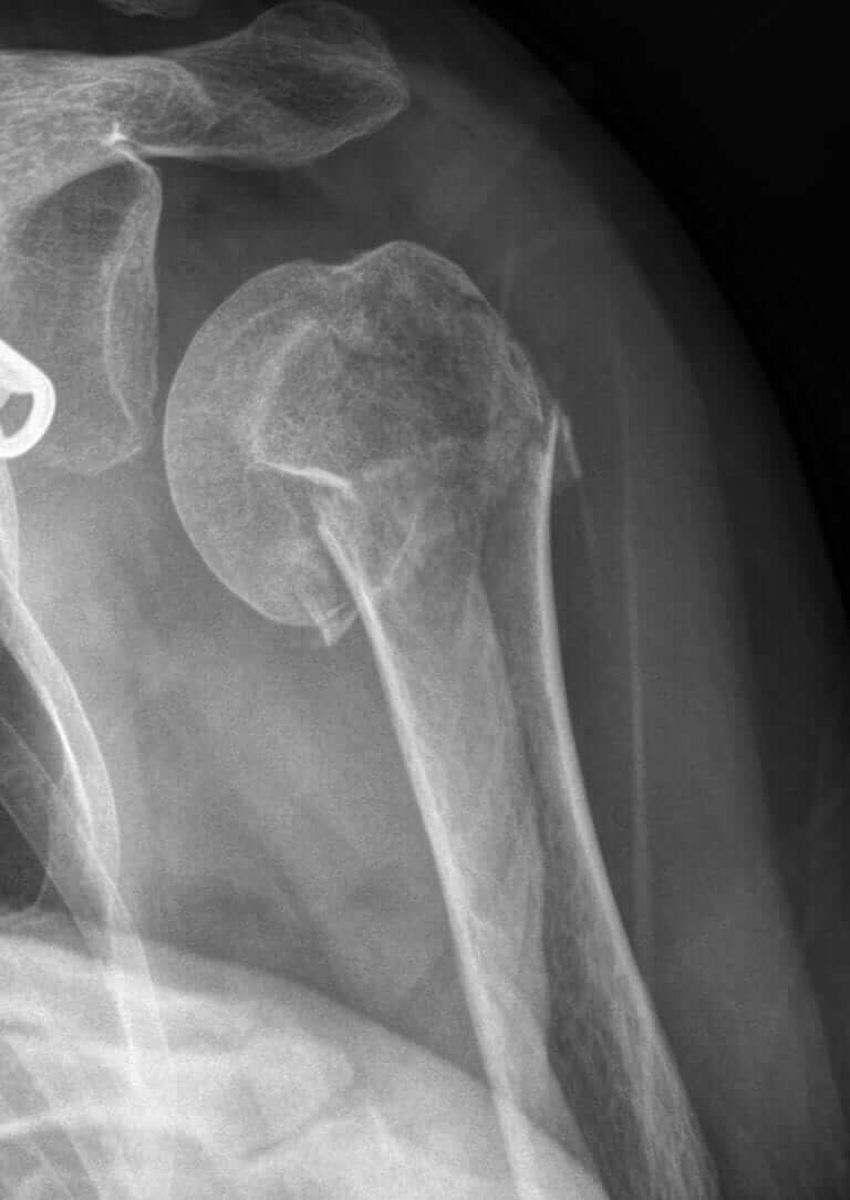 fractured-broken-shoulders-orthopaedic-surgeon-adelaide