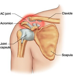 Shoulder injury and impact sports