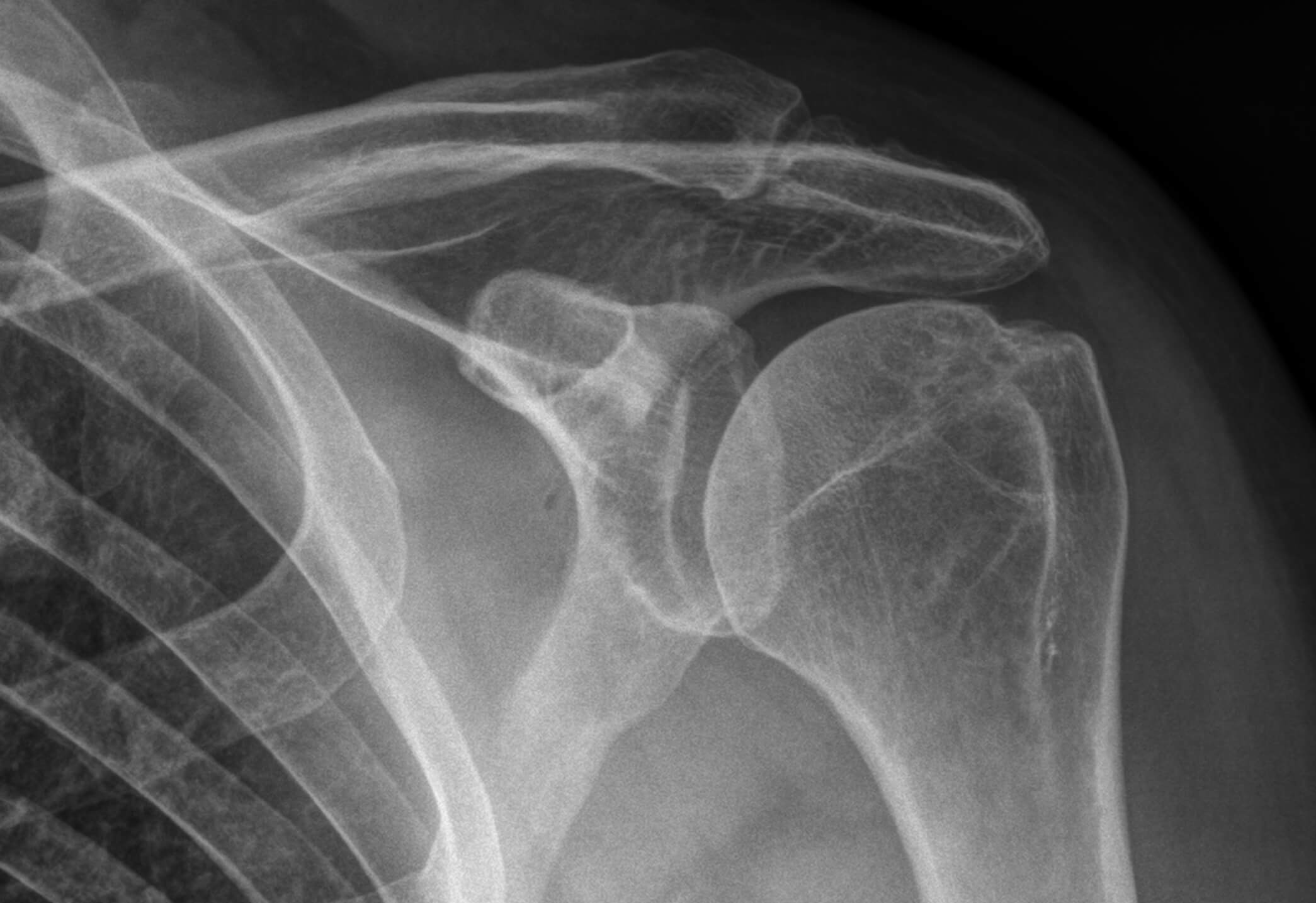 scrapbook foolish Separately AC Joint OsteoArthritis | Glenelg Orthopaedics
