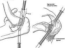 AC joint arthritis