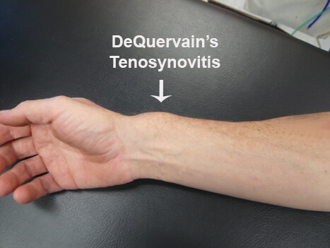 DeQuervain’s tenosynovitis