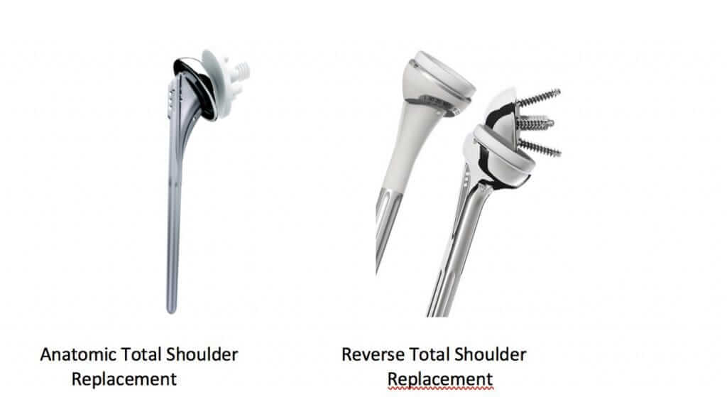 Types of Shoulder Replacements