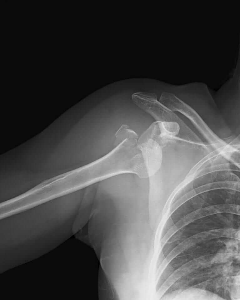 fractured-broken-shoulders-orthopaedic-surgeon-adelaide