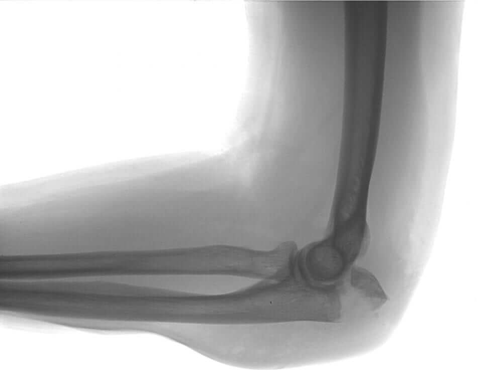 Elbow & Radial Head Fractures
