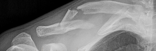 clavicle fracture