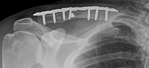 pathological disease of clavicle