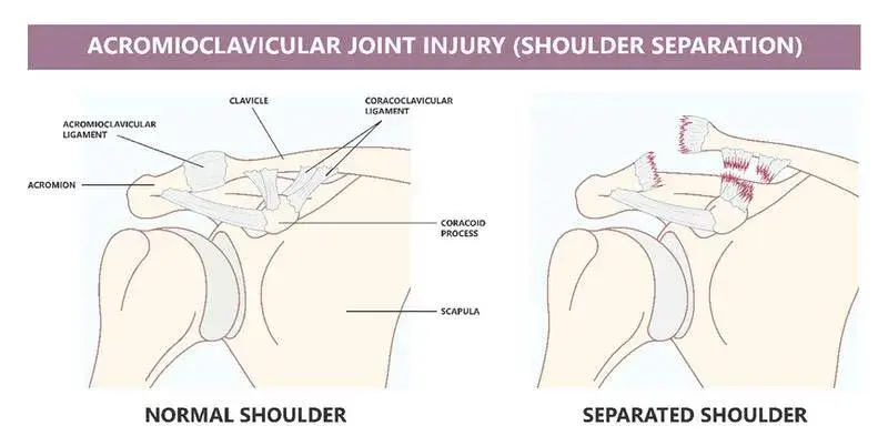 Exercises For AC Joint Injuries - [P]rehab