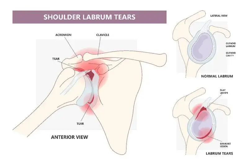 Shoulder Labrum Tears