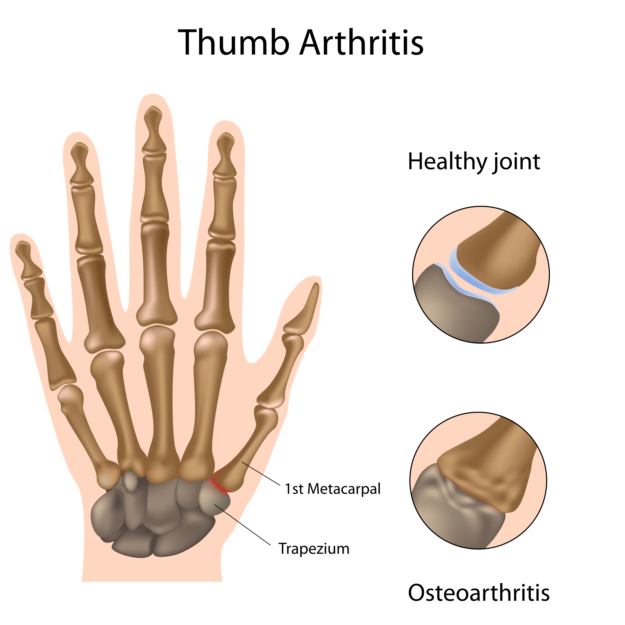 Basal Arthritis