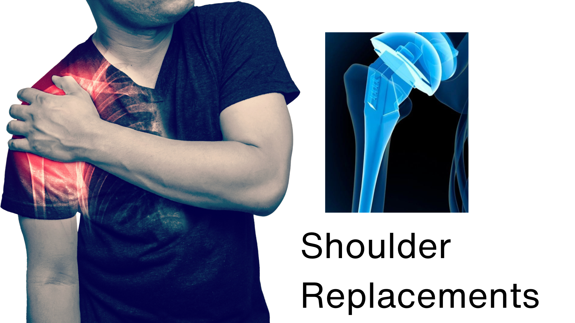 Shoulder Replacements Shouolder Replacements